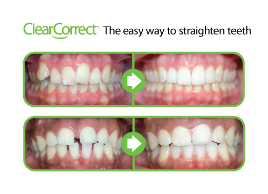 Edmonton Invisalign